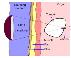 High-intensity focused ultrasound therapy market